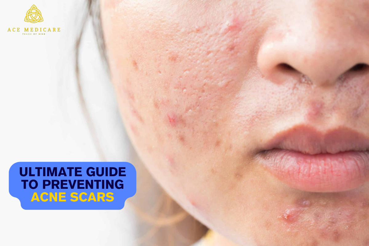 The Ultimate Guide to Preventing Acne Scars: Tips and Techniques